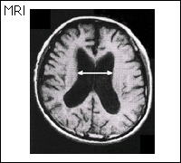 アルツハイマー型認知症の脳のＭＲＩ写真
