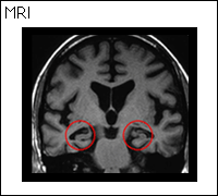 アルツハイマー型認知症の脳のＭＲＩ写真